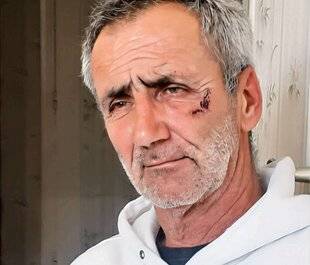 Closer 1040 ÉRIC “ Attaqué par un cannibale qui m'a mangé la joue, je suis marqué à vie ”
