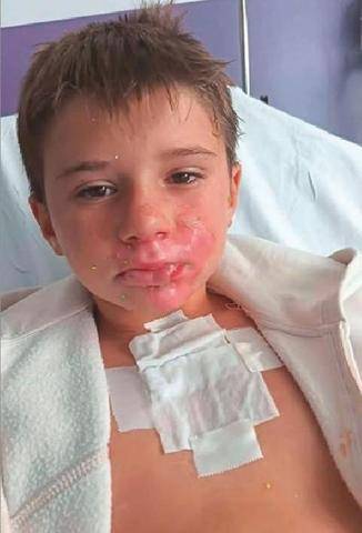 Closer 1107 Une balle antistress explose au visage d’un enfant de 8 ans, gravement brûlé