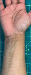 Nous Deux 4067 Un tatouage médical ?
