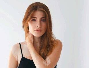 Nous Deux 4098 Vitiligo : le traitement est possible à tout âge !