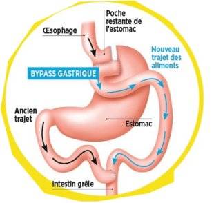 Top Santé 342 UNE CHIRURGIE DE L'OBÉSITÉ EN AMBULATOIRE
