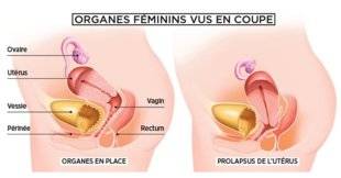 Top Santé 344 Une descente d'organes peut aussi entraîner des fuites