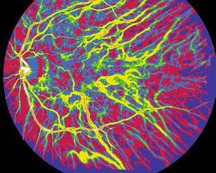 Top Santé 345 UN TEST OCULAIRE POUR DIAGNOSTIQUER ALZHEIMER ?