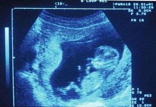 Top Santé 345 Une greffe de cellules-souches in utero