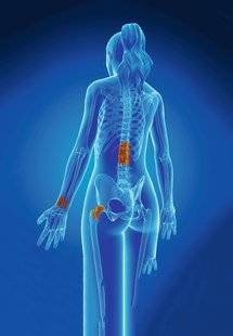 Top Santé 351 OÙ SE SITUENT LES FRACTURES QUAND LES OS SONT FRAGILES ?