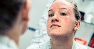 Top Santé 399 Ces problèmes de peau qui nous complexent