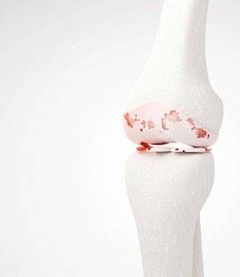 Top Santé 426 À l'intérieur d'une articulation arthrosique