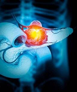 Top Santé 427 Un espoir de guérison dans le cancer du pancréas : des chercheurs sont parvenus à éliminer la tumeur chez des souris