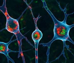 Top Santé 429 UN NOUVEAU BIOMARQUEUR POURPARKINSON ET LA MALADIE À CORPS DE LEWY