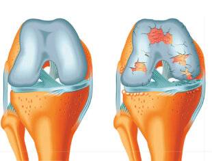 Hors-Séries 324 De nouvelles armes contre l'arthrose
