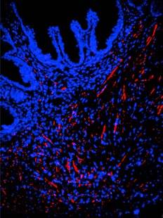 Science & Vie 1222 Les tumeurs ont des neurones !