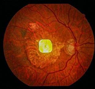 Science & Vie 1300 DES PATIENTS AVEUGLES REVOIENT PARTIELLEMENT