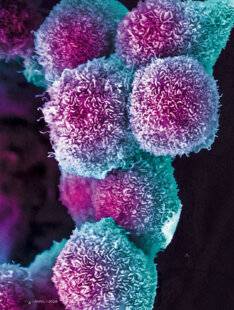 Science & Vie 1303 CANCER DU PANCRÉAS : Il n’est pas invincible