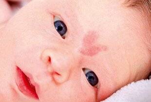 Science & Vie Découvertes 323 POURQUOI A-T-ON DES TACHES DE NAISSANCE ?