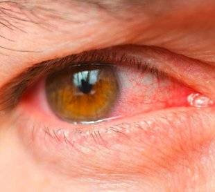 La Revue Nationale de La Chasse 860 Conjonctivite les yeux dans les yeux