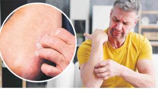 Les Veillées des Chaumières 3648 Enfin de nouvelles armes contre le psoriasis